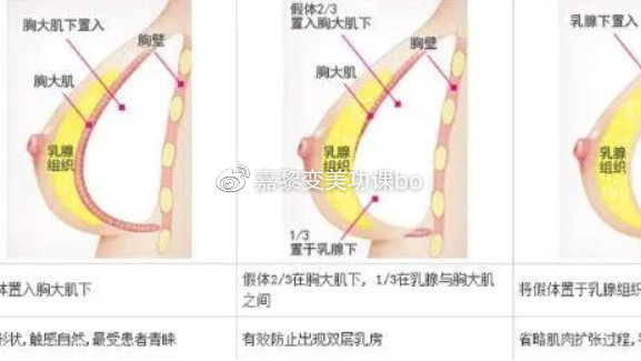 最新隆胸材料揭秘，小巷深处的美丽秘密探索