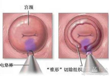 宫颈糜烂最新治疗手段和进展介绍